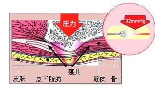 褥疮如何形成