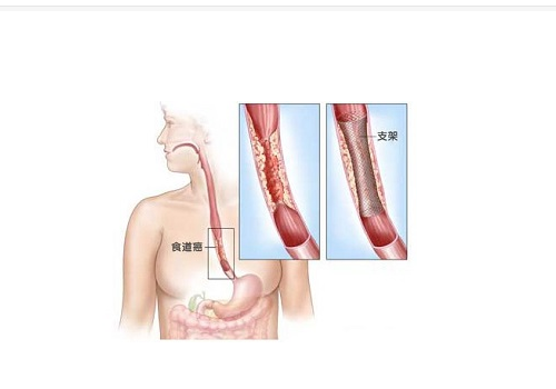 食道癌手术