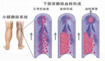 深静脉血栓