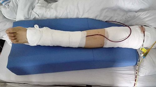 蒙泰护理C-012-03下肢抬高垫临床使用效果组图