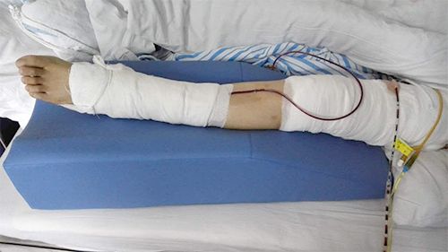 蒙泰护理C-012-03下肢抬高垫临床使用效果组图2